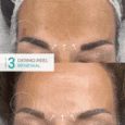 Dermo Peel Strength No.3_ Renewal Before & After Result