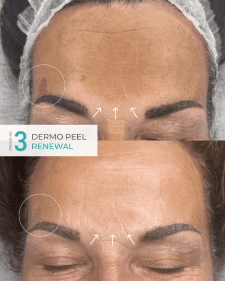 Dermo Peel Strength No.3_ Renewal Before & After Result